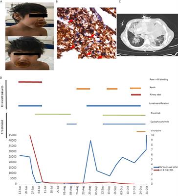 Case Report: Primary Immunodeficiencies, Massive EBV+ T-Cell Lympoproliferation Leading to the Diagnosis of ICF2 Syndrome